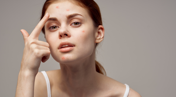 ¿Cómo combatir el acné y mantener una piel joven con monoi antiage?